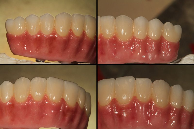 implant
