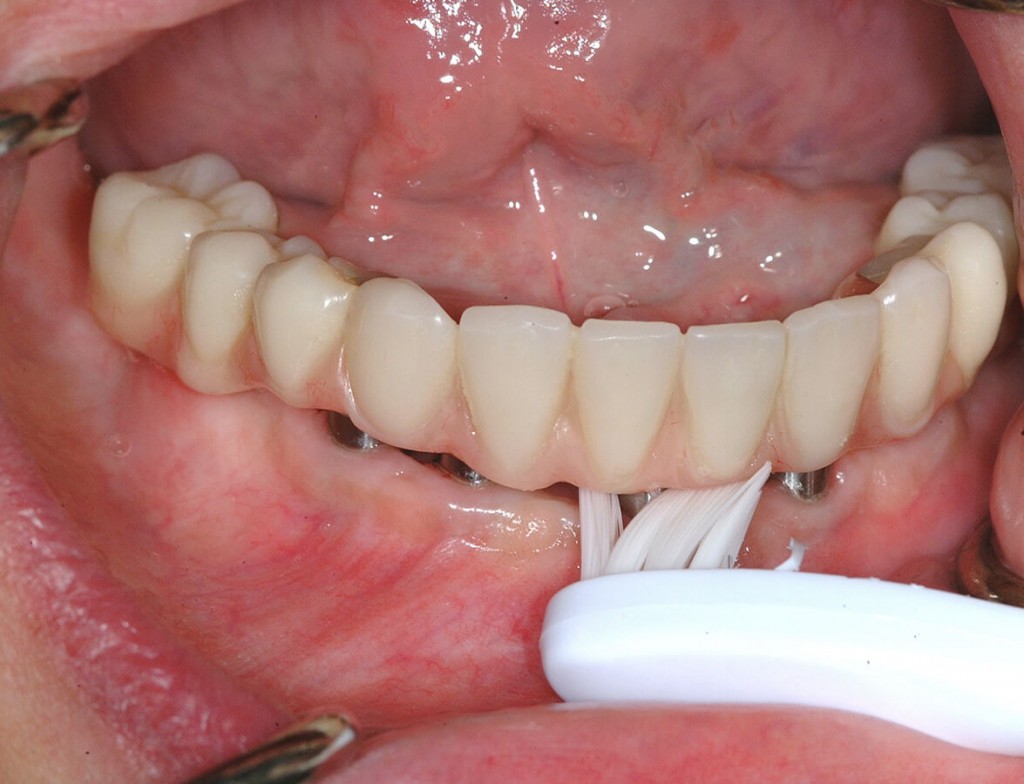 implant implant